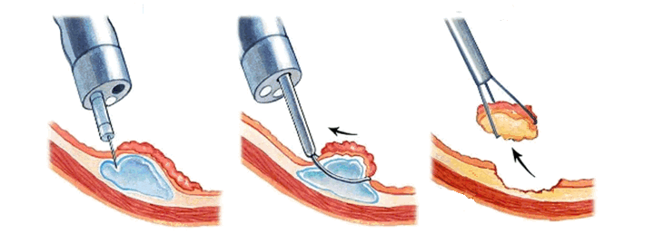 Illustration of Injection-assisted EMR