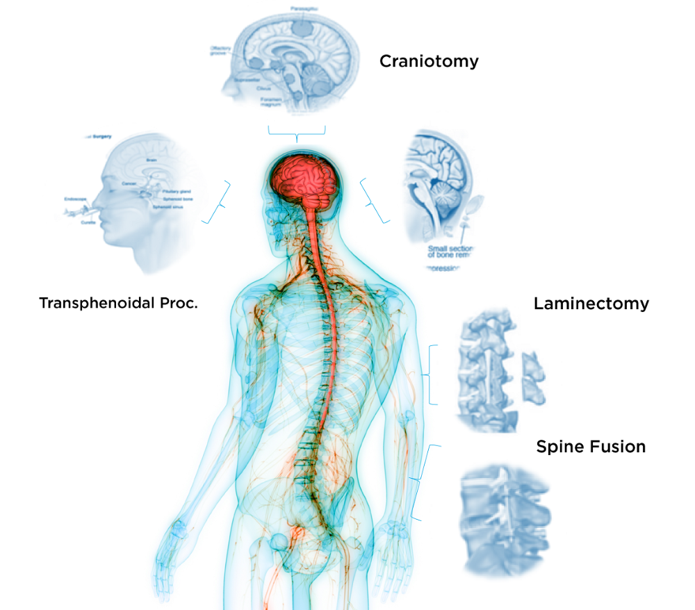 Sealant for Neurosurgery