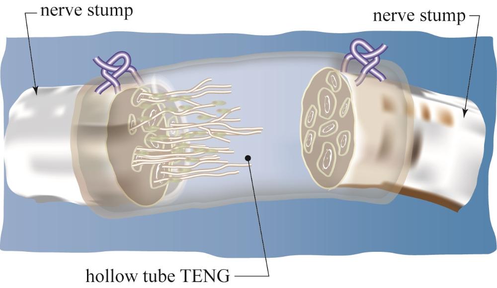 Aleo Nerve Conduit